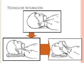 TÉCNICA DE INTUBACIÓN
 