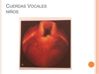 CUERDAS VOCALES
NIÑOS
 