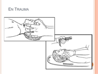 EN TRAUMA
 