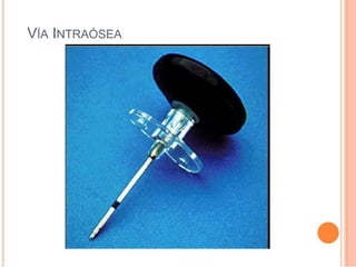 VÍA INTRAÓSEA
 