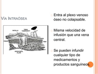 VÍA INTRAÓSEA
Entra al plexo venoso
óseo no colapsable.
Misma velocidad de
infusión que una vena
central.
Se pueden infundir
cualquier tipo de
medicamentos y
productos sanguíneos.
 