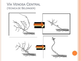 VÍA VENOSA CENTRAL
(TÉCNICA DE SELDINGER)
 