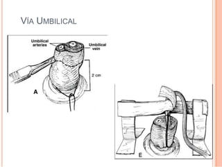 VÍA UMBILICAL
 