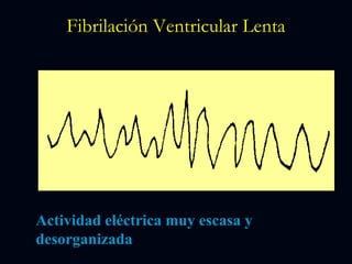 Fibrilación Ventricular Lenta
Actividad eléctrica muy escasa y
desorganizada
 