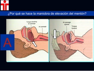 ¿Por qué se hace la maniobra de elevación del mentón?
A
 