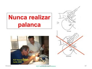Nunca realizar
palanca
RCP Neonatal/César Amanzo
RCP Neonatal ENED
Junio 2009
Amanzo RCP Neonatal 87
 
