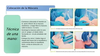 Colocación de la Máscara
•Comience colocando el mentón en
la parte inferior de la mascara
anatómica y luego lleve la mascara
sobre la boca y la nariz.
•Sostenga la mascara sobre la cara
con el pulgar y el dedo índice
formando un circulo alrededor del
borde.
•Coloque los otros 3 dedos bajo el
ángulo del hueso de la mandíbula y
suavemente eleve la mandíbula
hacia arriba en dirección a la
mascara.
Técnica
de una
mano:
 