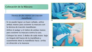 Colocación de la Máscara
Técnica de dos manos con tracción
mandibular:
•Si no puede lograr un buen sellado, utilice
ambas manos para sostener la mascara con
la técnica de tracción mandibular.
•Utilice el pulgar y el índice de ambas manos
para sostener la mascara contra la cara.
•Coloque los otros 3 dedos de cada mano bajo
en Angulo del hueso de la mandíbula y
suavemente eleve la mandíbula hacia arriba
en dirección a la mascara
 