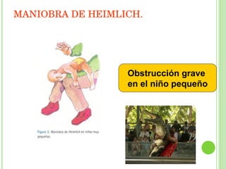 Obstrucción grave  en el niño pequeño MANIOBRA DE HEIMLICH. 
