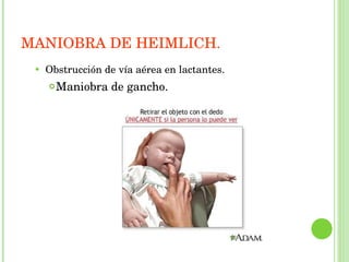 Obstrucción de vía aérea en lactantes. Maniobra de gancho. MANIOBRA DE HEIMLICH. 