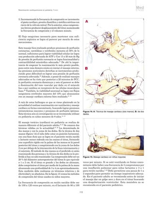 Med
Reanimación cardiopulmonar en pediatría. Forero                                                                                  UNAB


3. Incrementando la frecuencia de compresión se incrementa
   el gasto cardíaco, presión diastólica y sistólica aórticas con
   cierre de la válvula mitral. Por lo anterior, estas compresio-
   nes breves producen desplazamiento del tórax aumentando
   la frecuencia de compresión y el volumen minuto.

El flujo sanguíneo necesario para mantener una sufi-
ciencia orgánica se logra al parecer por mezcla de estos
mecanismos.

Este masaje bien realizado produce presiones de perfusión
coronarias, carotídeas y cerebrales menores al 30% de lo
normal, suficientes para lograr viabilidad celular (se logra
una producción adecuada de ATP ). Con 15 a 20 mm de Hg
de presión de perfusión coronaria se logra funcionalidad y
contractibilidad miocárdica adecuada.24 De ahí la impor-
tancia de empezar la reanimación lo más pronto posible,
pues entre más demora exista en iniciar el masaje externo,
las presiones auriculares derechas se incrementan produ-
ciendo gran dificultad en lograr una presión de perfusión
coronaria adecuada.25 Además, a pesar de realizar masajes
adecuados se ha visto que posterior a 20 minutos de PCC,
la perfusión coronaria disminuye y esto al parecer se debe
a disminución del tono vascular por daño en el músculo
liso o por cambios en receptores de las células musculares
lisas.26 También, la viabilidad neuronal se logra con flujos
sanguíneos cerebrales mayores del 10% que alcanzamos
con un masaje cardíaco externo bien realizado.21, 22

A raíz de estos hallazgos es que se viene planteado en la
actualidad el realizar reanimación con ventilación y masaje
cardíaco en forma concomitante, buscando lograr presiones
intratorácicas mayores y presiones de perfusión óptimas.                  Figura 14. A: Técnica de masaje cardiaco (dos manos); B: de dos
Esta técnica aún en investigación no se recomienda utilizar               dedos.
en pediatría en niños menores de 8 años.12, 18

El masaje torácico (cardíaco) en pediatría se realiza de
manera diferente al del paciente adulto.23, 27 Se conocen dos
técnicas válidas en la actualidad:18, 28 La denominada de
dos manos y con la yema de los dedos. En la técnica de dos
manos (figura 14) el niño debe estar en posición horizontal,
con una base dura que se logra en el paciente recién nacido
y lactante menor rodeado con las manos el tórax, formando
una superficie rígida con la palma de las manos en la pared
posterior del tórax y comprimiendo con la yema de los dedos
2 cm por debajo de la intersección de la línea intermamaria y
el esternón. El método de dos manos es el preferido si están
reanimando dos personas y la técnica de dos dedos es la pre-
ferida si hay un solo reanimador. La comprensión debe ser un              Figura 15. Masaje cardiaco en niños mayores
20 % del diámetro anteroposterior del tórax lo que equivale
a 1 a 2 cm. Si el tórax es grande y los dedos no alcanzan,                veces por minuto. Si se está ventilando en forma conco-
debe comprimirse el tórax por medio de la palma de la mano                mitante debe haber una frecuencia de 5 compresiones por
alcanzando una profundidad de 3 a 4 cm aproximadamente.                   una insuflación pulmonar para niños lactantes y 3 a 1
Esta medición debe realizarse en términos relativos y de                  para recién nacidos.2, 28 Debe permitirse una pausa de 1 a
efectividad y no absolutos. En la figura 15 vemos los métodos             2 segundos para permitir un tiempo inspiratorio adecua-
de compresión del tórax usados en niños mayores.                          do. En el paciente adulto se recomienda antes de iniciar
                                                                          el masaje dar un golpe seco y duro en el tórax buscando
La frecuencia de compresión en recién nacidos debe ser                    una despolarización ventricular. Esta maniobra no se
de 100 a 120 veces por minuto, en el lactante de 80 a 100                 recomienda en el paciente pediátrico.


                                                                    115
 