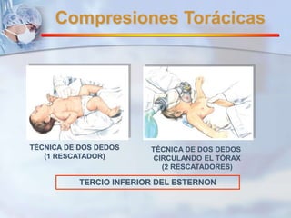 Compresiones Torácicas 
TÉCNICA DE DOS DEDOS 
(1 RESCATADOR) 
TÉCNICA DE DOS DEDOS 
CIRCULANDO EL TÓRAX 
(2 RESCATADORES) 
TERCIO INFERIOR DEL ESTERNON 
 