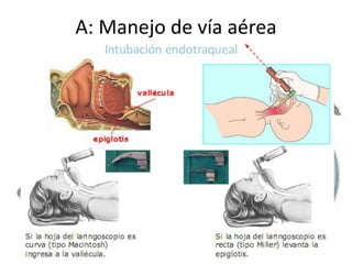 A: Manejo de vía aérea

 