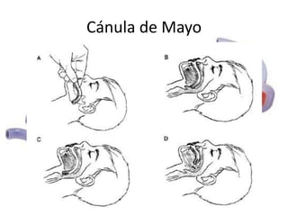 Cánula de Mayo

 