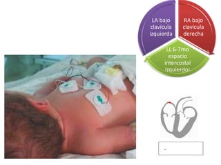 LA bajo
clavícula
izquierda

RA bajo
clavícula
derecha

LL 6-7mo
espacio
intercostal
izquierdo¡

 