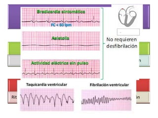 EKG y Desfibilación

Bradicardia Sintomática y Asistolia
Comunes en niños

No requieren desfibrilación

TV sin pulso y FV
Ritmos infrecuentes en pediatría

Sí requieren desfibrilación

 