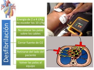 Desfibrilación

Energía de 2 a 4 J/Kg,
no esceder los 10 J/Kg
No colocar las palas
sobre los cables
Cerrar fuente de O2

Retirarse del lado del
paciente
Volver las palas al
equipo

 