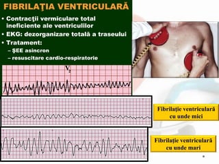 FIBRILAŢIA VENTRICULARĂ
• Contracţii vermiculare total
ineficiente ale ventriculilor
• EKG: dezorganizare totală a traseului
• Tratament:
– ŞEE asincron
– resuscitare cardio-respiratorie
Fibrilaţie ventriculară
cu unde mici
Fibrilaţie ventriculară
cu unde mari
 
