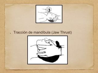 Tracción de mandíbula (Jaw Thrust)
 