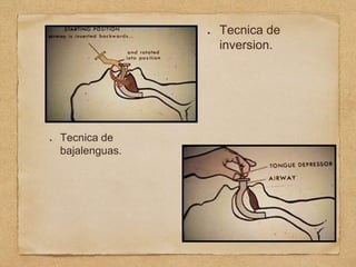 Tecnica de
inversion.
Tecnica de
bajalenguas.
 