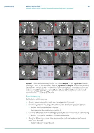 rcr_publications_national_rectal_cancer_intensity_modulated ...