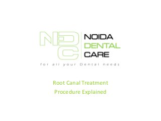 Root Canal Treatment
Procedure Explained

 