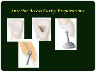 Root canal treatment acess cavity preparation | PPTX