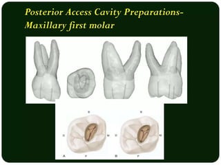 Root canal treatment acess cavity preparation | PPTX