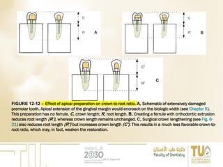 FIGURE 12-12 ■ Effect of apical preparation on crown-to-root ratio. A, Schematic of extensively damaged
premolar tooth. Apical extension of the gingival margin would encroach on the biologic width (see Chapter 5).
This preparation has no ferrule. C, crown length; R, root length. B, Creating a ferrule with orthodontic extrusion
reduces root length (R′), whereas crown length remains unchanged. C, Surgical crown lengthening (see Fig. 6-
21) also reduces root length (R′) but increases crown length (C′). This results in a much less favorable crown-to-
root ratio, which may, in fact, weaken the restoration.
DR EL Sayed Ali
 