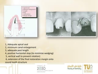 1, Adequate apical seal
2, minimum canal enlargement
3, adequate post length
4, positive horizontal stop (to minimize wedging)
5, vertical wall to prevent rotation)
6, extension of the final restoration margin onto
sound tooth structure
DR EL Sayed Ali
 