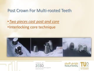 •Two pieces cast post and core
•Interlocking core technique
DR EL Sayed Ali
 