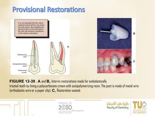 FIGURE 12-39 ■ A and B, Interim restorations made for endodontically
treated teeth by lining a polycarbonate crown with autopolymerizing resin. The post is made of metal wire
(orthodontic wire or a paper clip). C, Restoration seated.
DR EL Sayed Ali
 