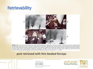 post retrieved with thin-beaked forceps
DR EL Sayed Ali
 