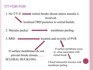 RETINAL DETACHMENT | PPTX
