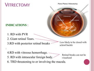 RETINAL DETACHMENT | PPTX