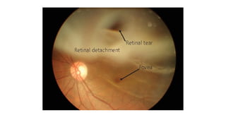 Retinal Detachment Rosh Retinal Detachment | Ophthalmology | PPT