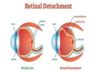 Total R&d Eye Rd | PPT