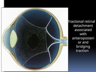 Tractional retinal
detachment
associated
with
anteroposteri
or and
bridging
traction
 