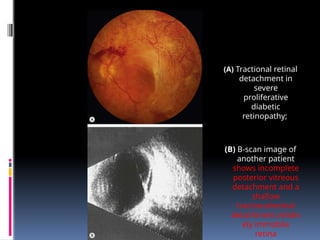 (A) Tractional retinal
detachment in
severe
proliferative
diabetic
retinopathy;
(B) B-scan image of
another patient
shows incomplete
posterior vitreous
detachment and a
shallow
tractionalretinal
detachment,relativ
ely immobile
retina
 