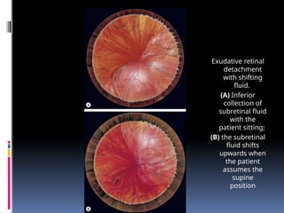 Exudative retinal
detachment
with shifting
fluid.
(A) Inferior
collection of
subretinal fluid
with the
patient sitting;
(B) the subretinal
fluid shifts
upwards when
the patient
assumes the
supine
position
 