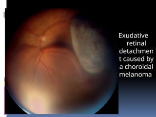 Exudative
retinal
detachmen
t caused by
a choroidal
melanoma
 
