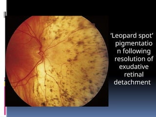 ‘Leopard spot’
pigmentatio
n following
resolution of
exudative
retinal
detachment
 