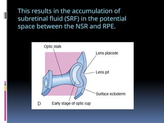 This results in the accumulation of
subretinal fluid (SRF) in the potential
space between the NSR and RPE.
 