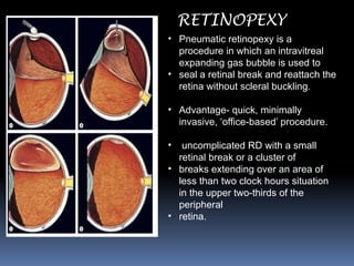 • Pneumatic retinopexy is a
procedure in which an intravitreal
expanding gas bubble is used to
• seal a retinal break and reattach the
retina without scleral buckling.
• Advantage- quick, minimally
invasive, ‘office-based’ procedure.
• uncomplicated RD with a small
retinal break or a cluster of
• breaks extending over an area of
less than two clock hours situation
in the upper two-thirds of the
peripheral
• retina.
RETINOPEXY
 