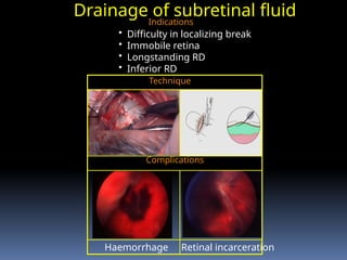 Drainage of subretinal fluid
Indications
Haemorrhage
• Difficulty in localizing break
• Immobile retina
• Longstanding RD
• Inferior RD
Retinal incarceration
Complications
Technique
 