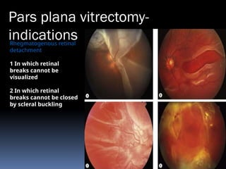 Rhegmatogenous retinal
detachment
1 In which retinal
breaks cannot be
visualized
2 In which retinal
breaks cannot be closed
by scleral buckling
Pars plana vitrectomy-
indications
 