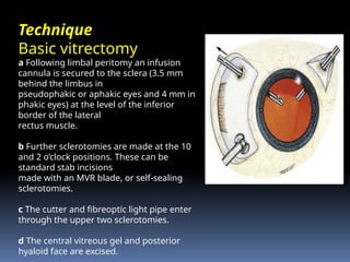 Technique
Basic vitrectomy
a Following limbal peritomy an infusion
cannula is secured to the sclera (3.5 mm
behind the limbus in
pseudophakic or aphakic eyes and 4 mm in
phakic eyes) at the level of the inferior
border of the lateral
rectus muscle.
b Further sclerotomies are made at the 10
and 2 o’clock positions. These can be
standard stab incisions
made with an MVR blade, or self-sealing
sclerotomies.
c The cutter and fibreoptic light pipe enter
through the upper two sclerotomies.
d The central vitreous gel and posterior
hyaloid face are excised.
 