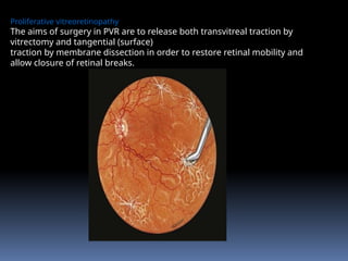 Proliferative vitreoretinopathy
The aims of surgery in PVR are to release both transvitreal traction by
vitrectomy and tangential (surface)
traction by membrane dissection in order to restore retinal mobility and
allow closure of retinal breaks.
 