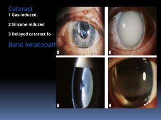 Cataract
1 Gas-induced.
2 Silicone-induced
3 Delayed cataract formation.
Band keratopathy
 