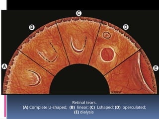 Retinal tears.
(A) Complete U-shaped; (B) linear; (C) Lshaped; (D) operculated;
(E) dialysis
 
